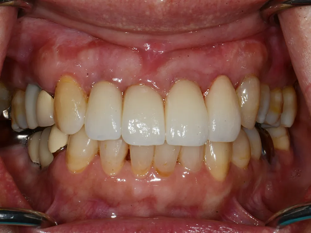 CASE41