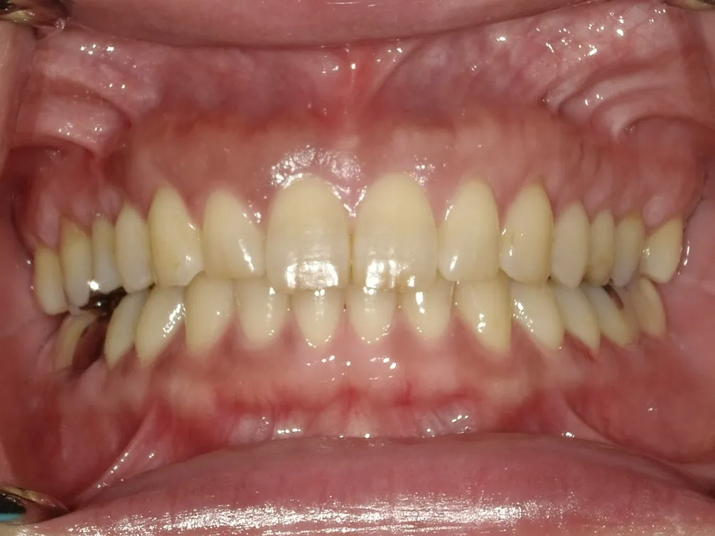 CASE14