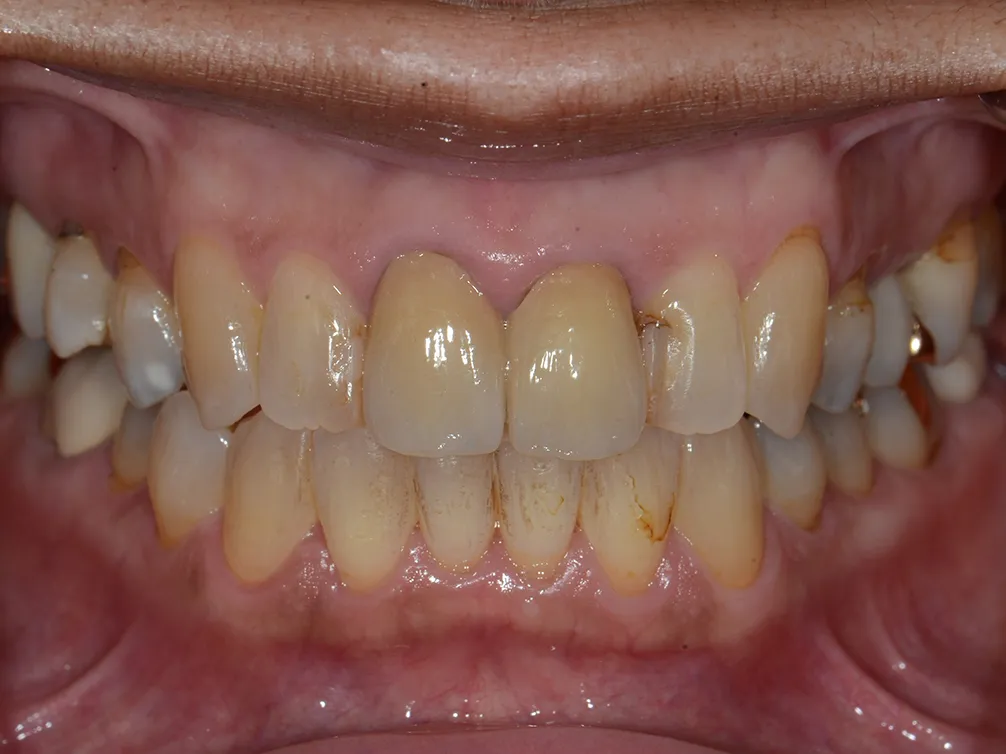 CASE11