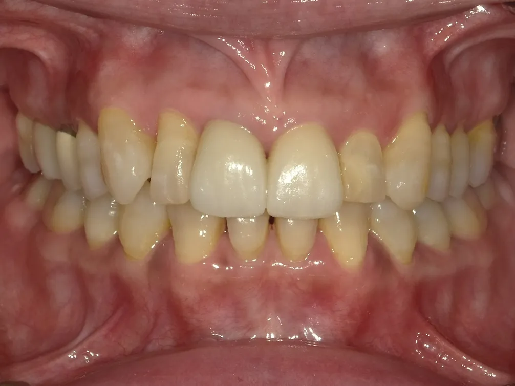 CASE25