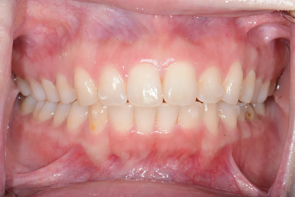 CASE26