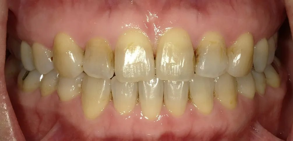 CASE15