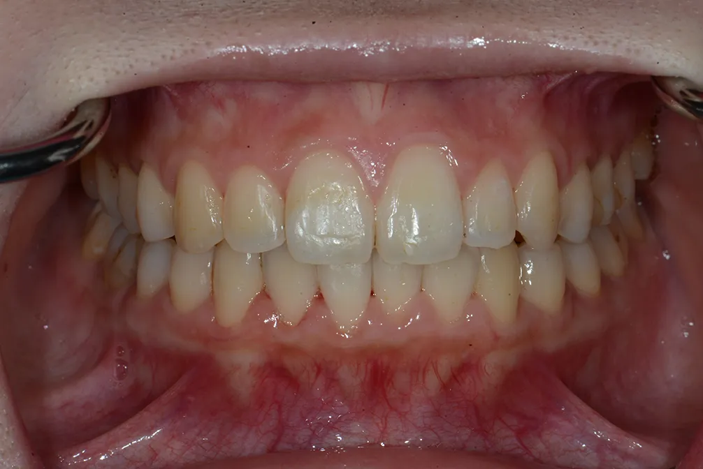 CASE27