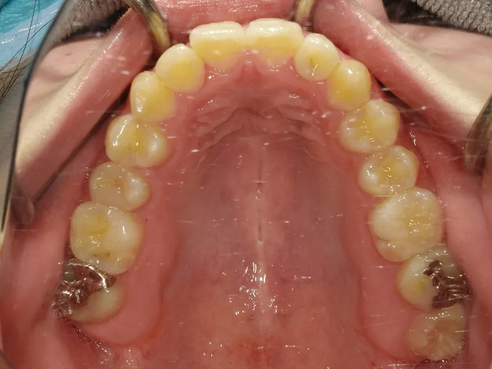 CASE21