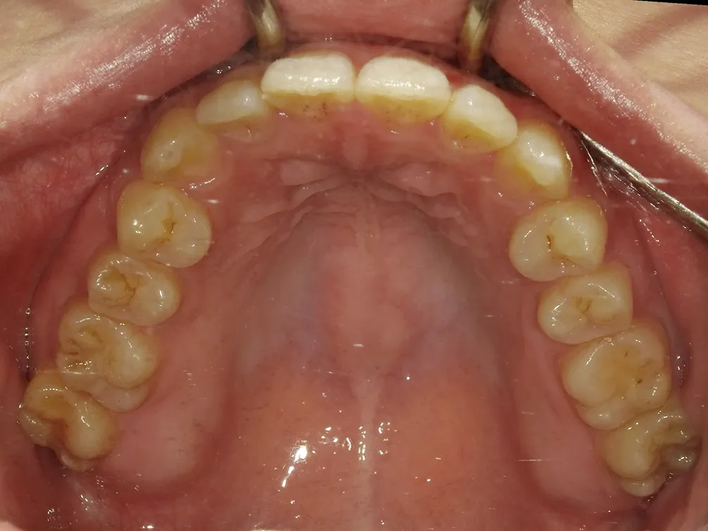 CASE23
