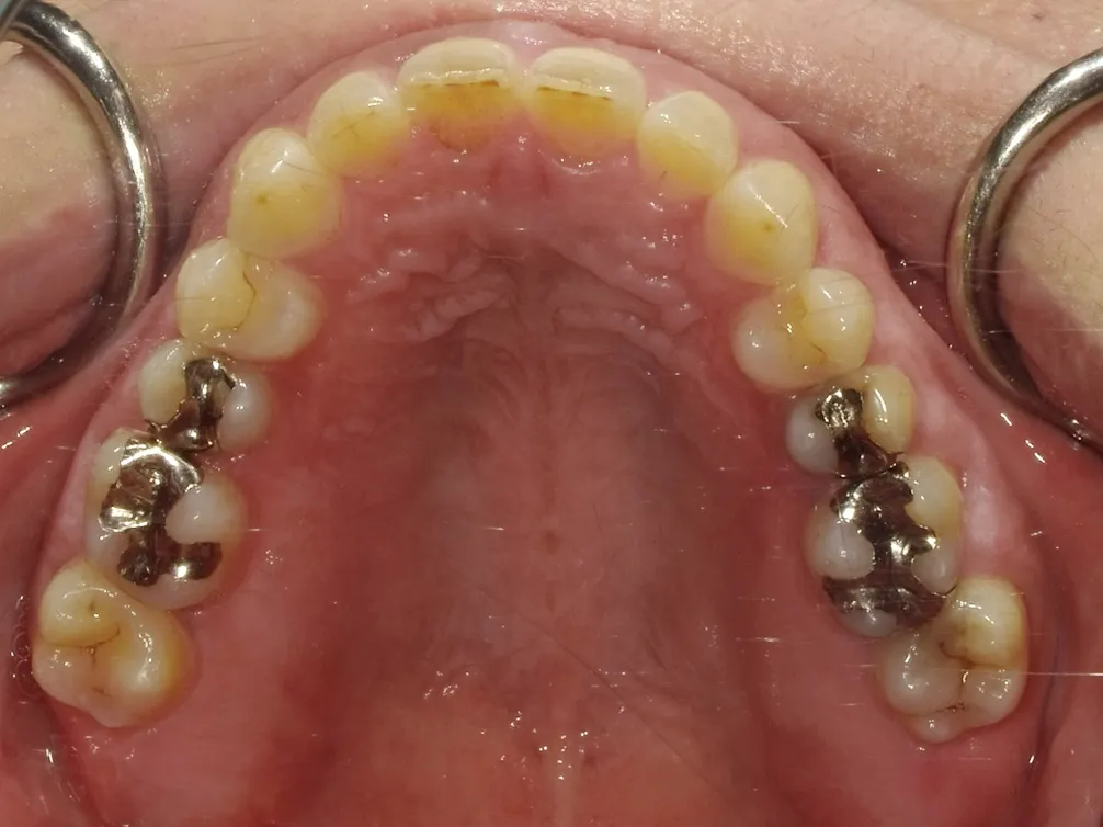 CASE14