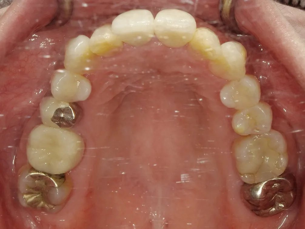 CASE25