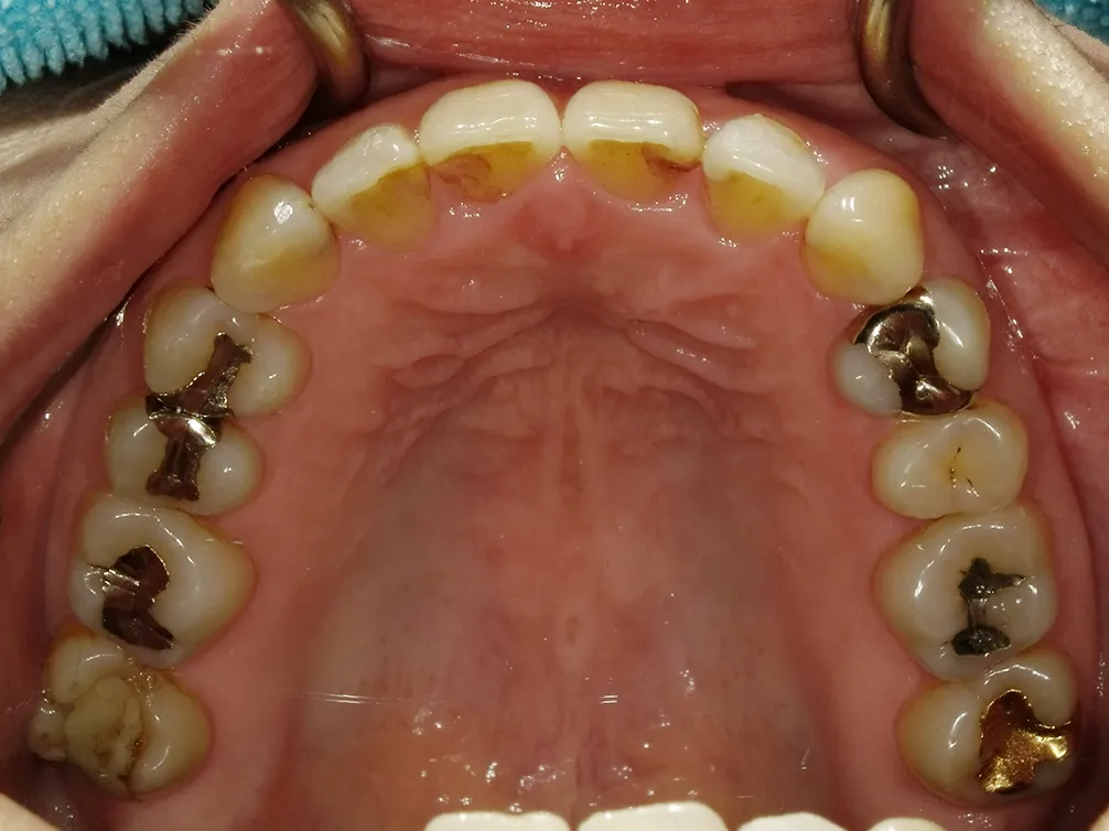 CASE15