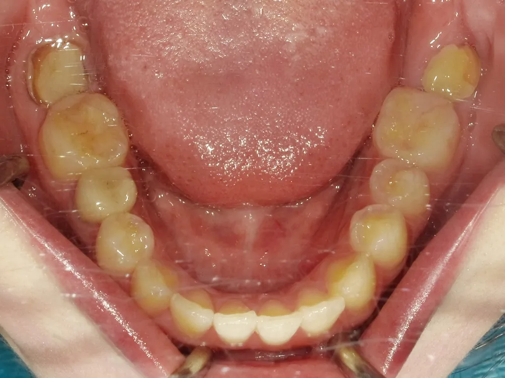 CASE21