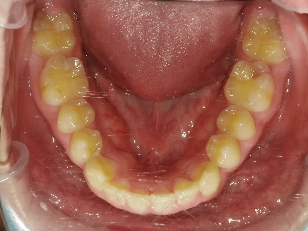 CASE22