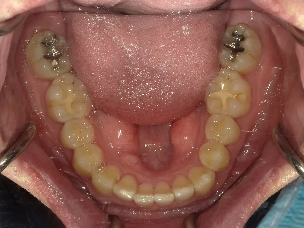 CASE28