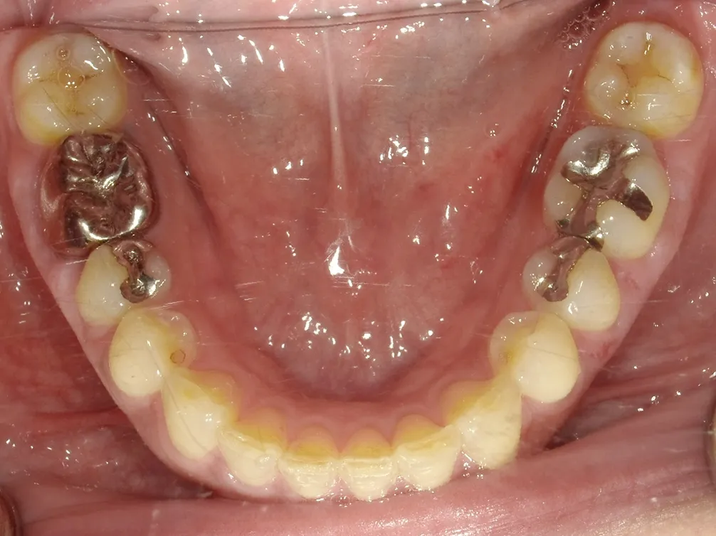CASE14