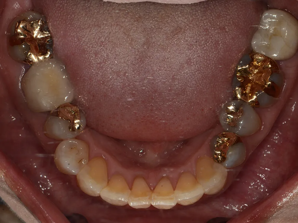 CASE11