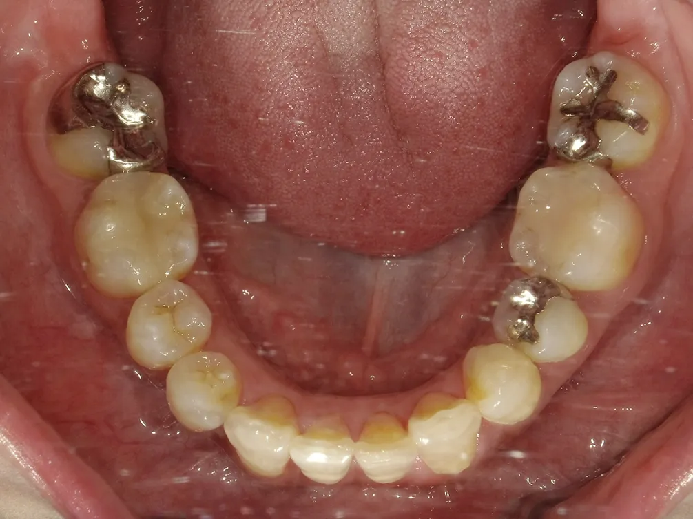 CASE25
