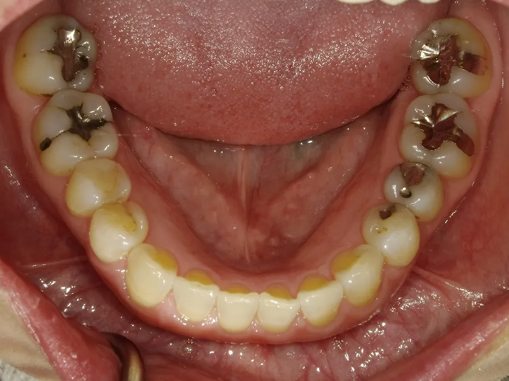 CASE15