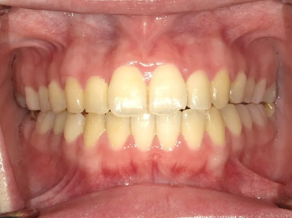 CASE21