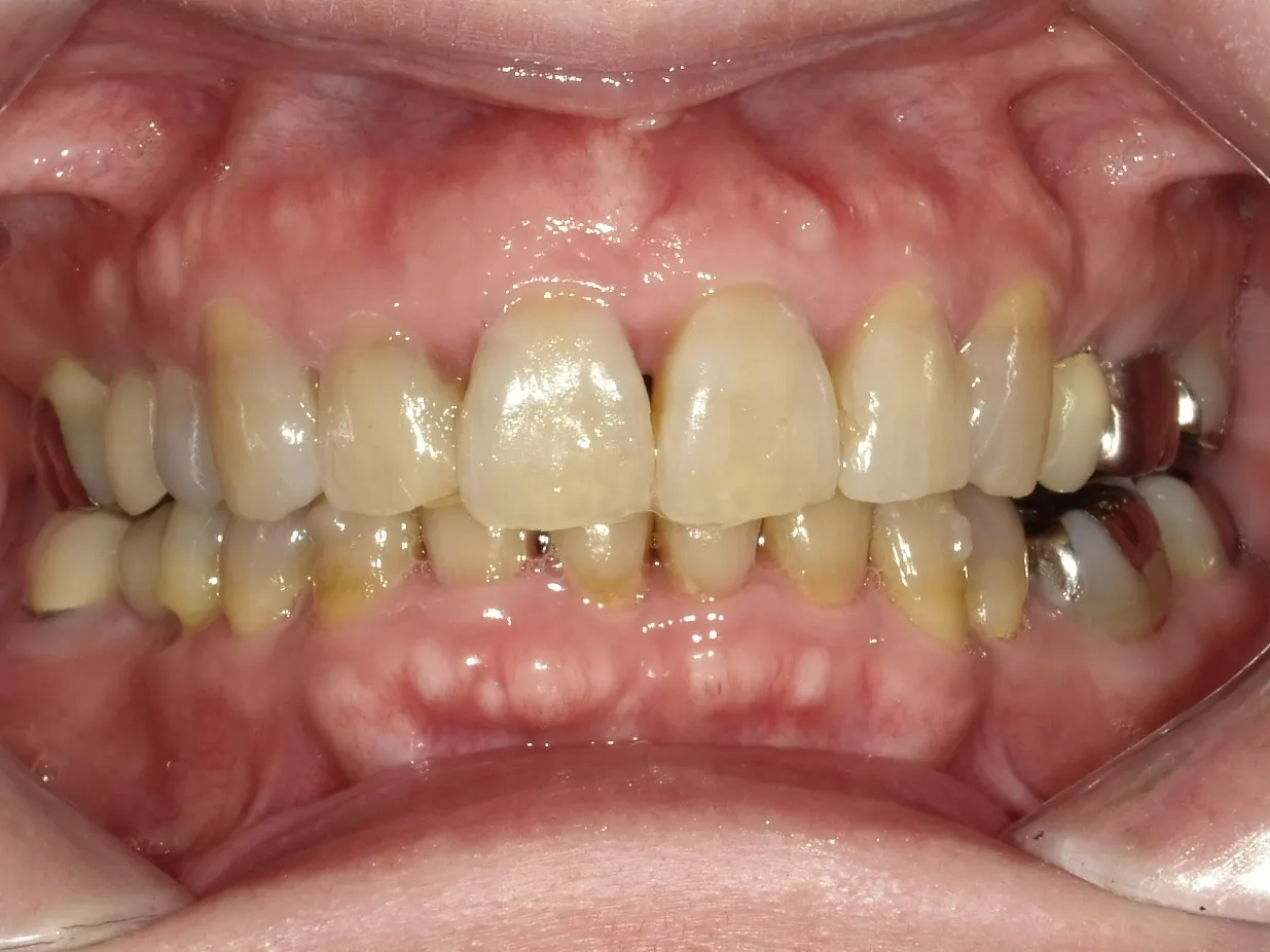 CASE15
