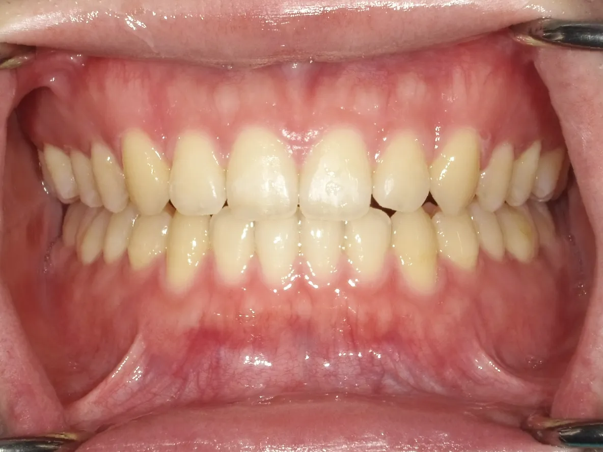 CASE15