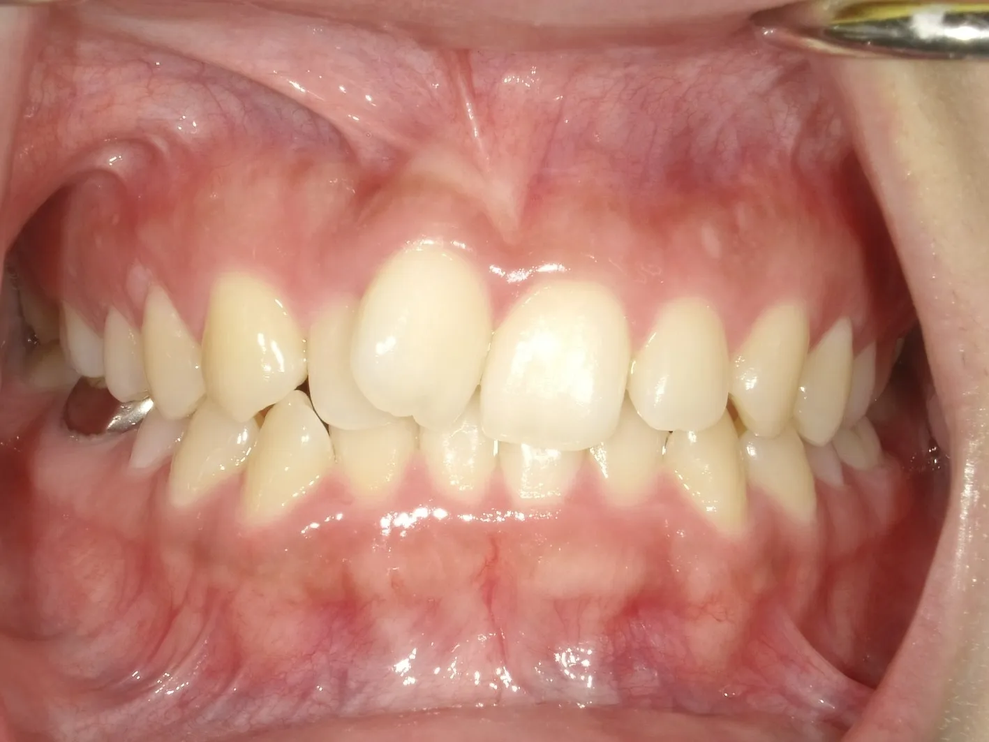 CASE17