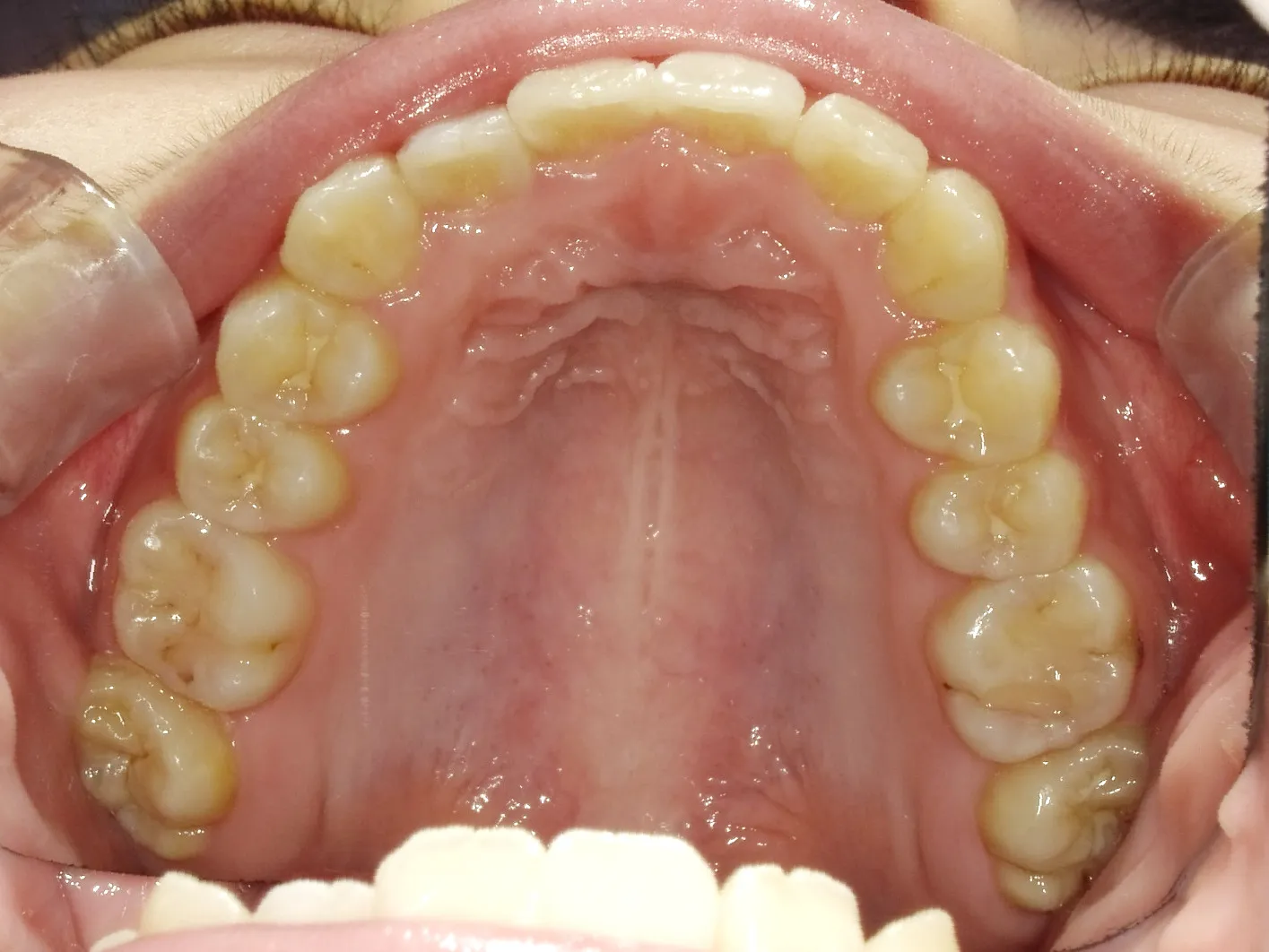 CASE17