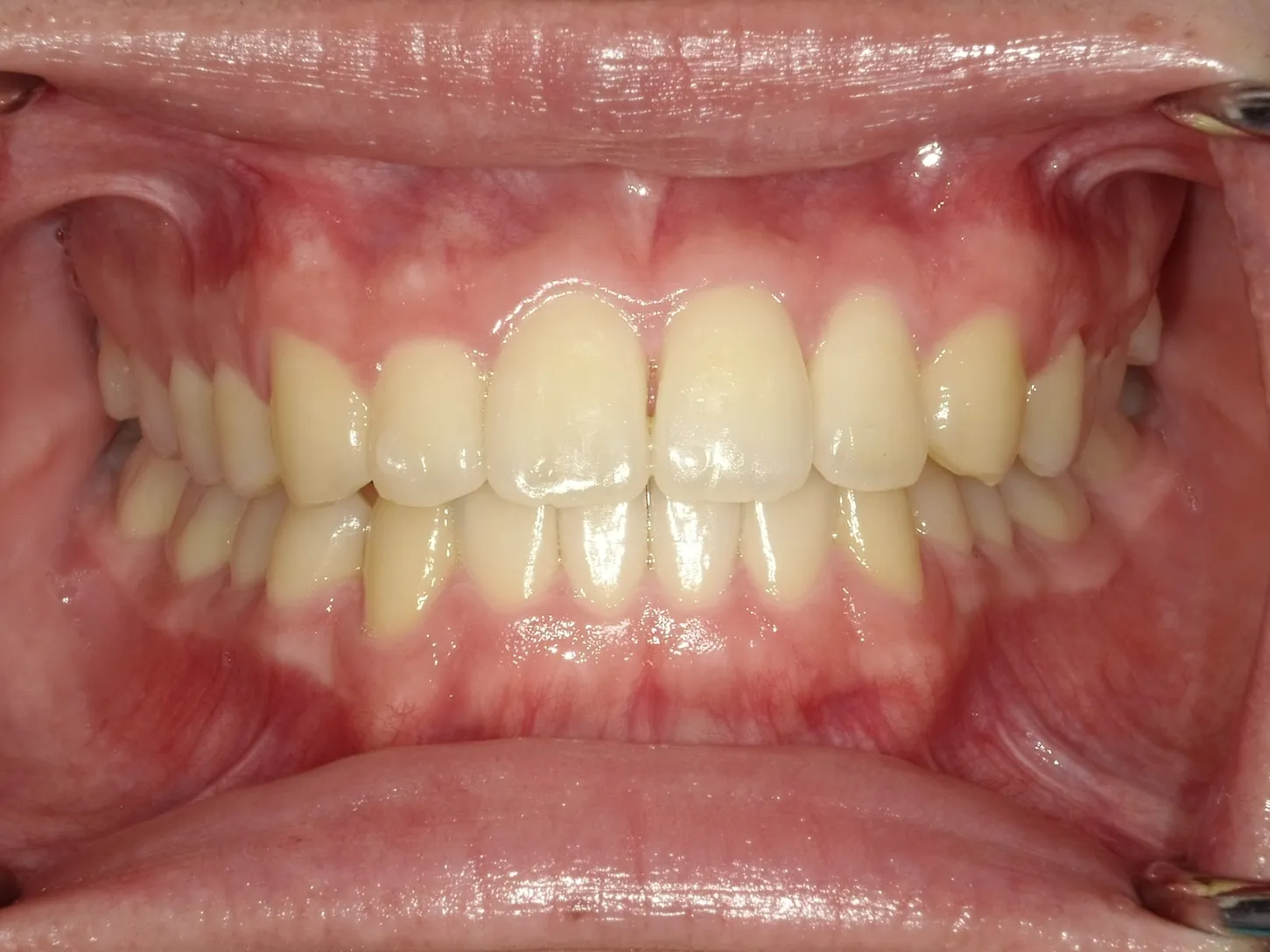 CASE18