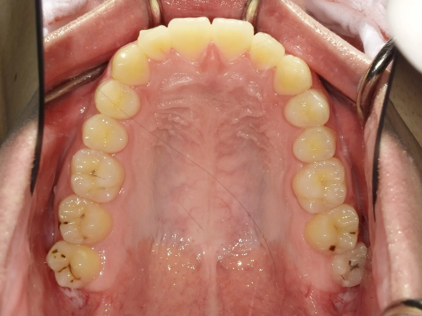 case18