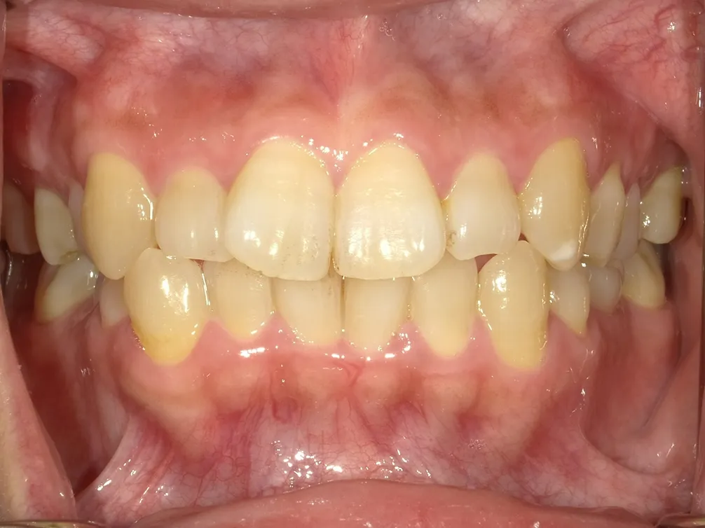 CASE23