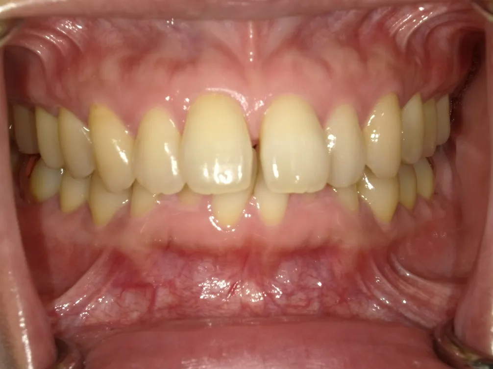 CASE16