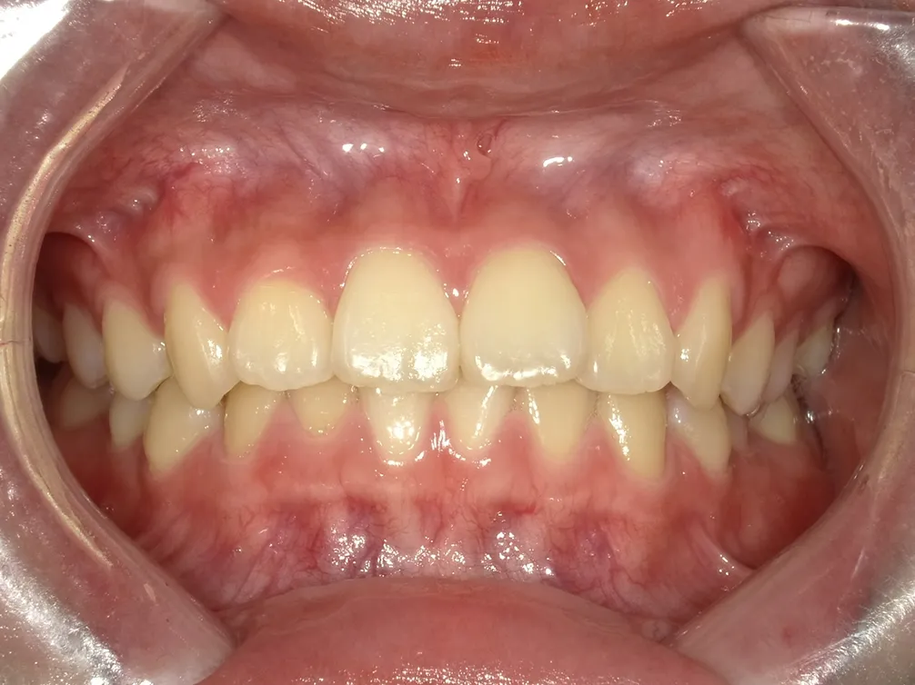 CASE4
