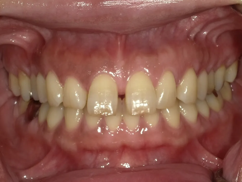 CASE14