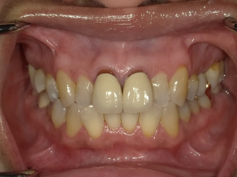 CASE11