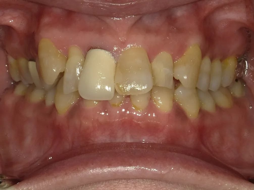 CASE25