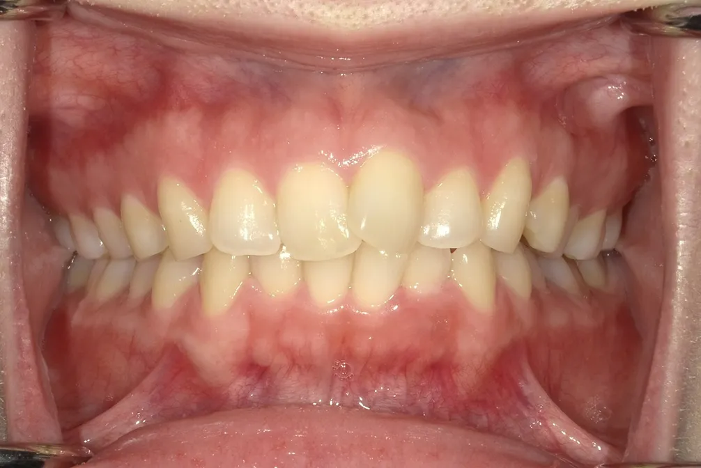 CASE26