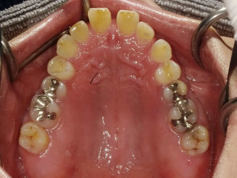 CASE14