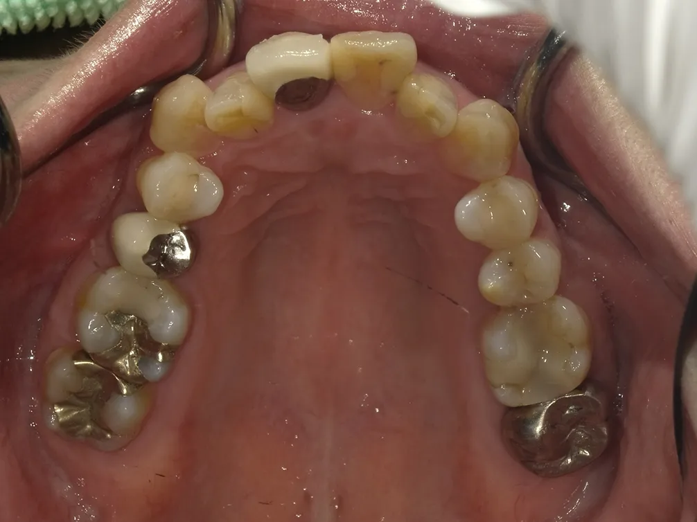 CASE25