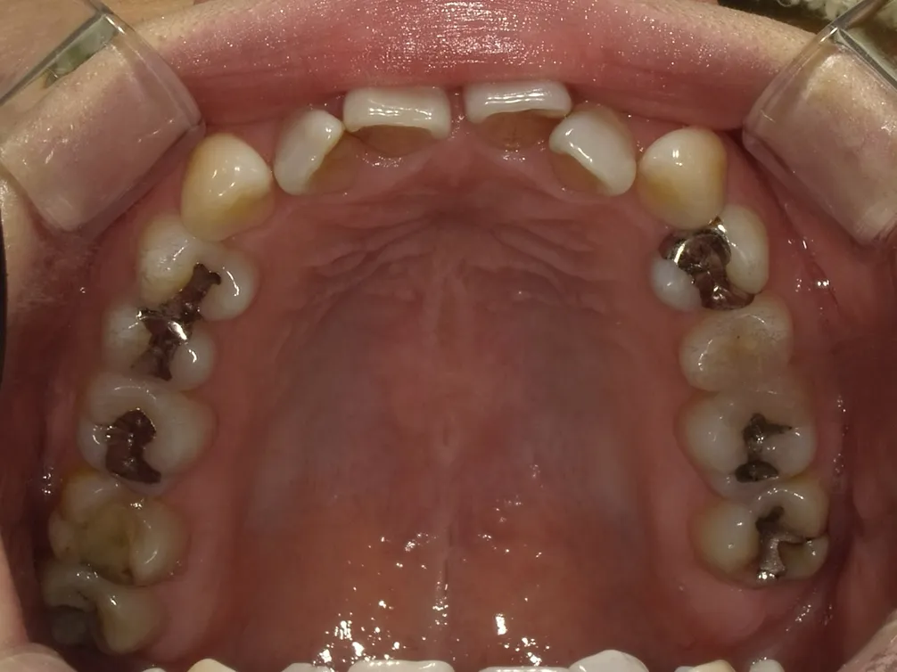 CASE15