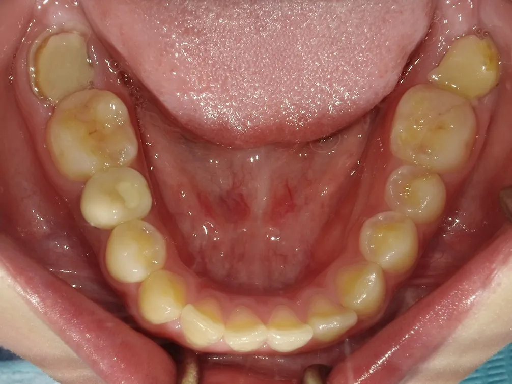 CASE21