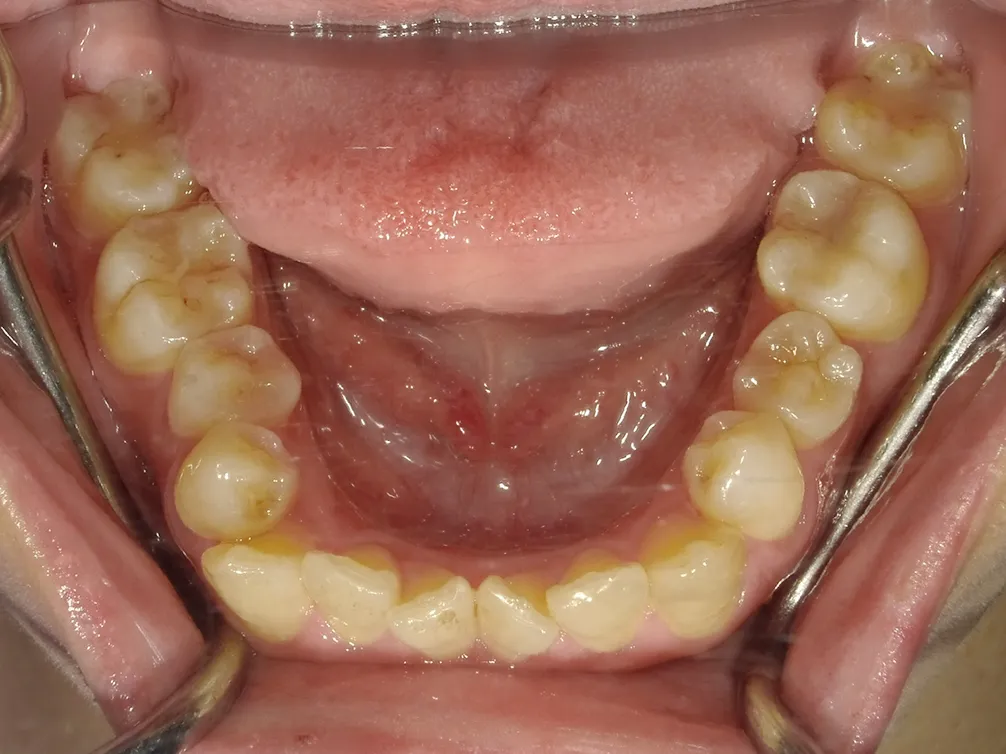CASE23