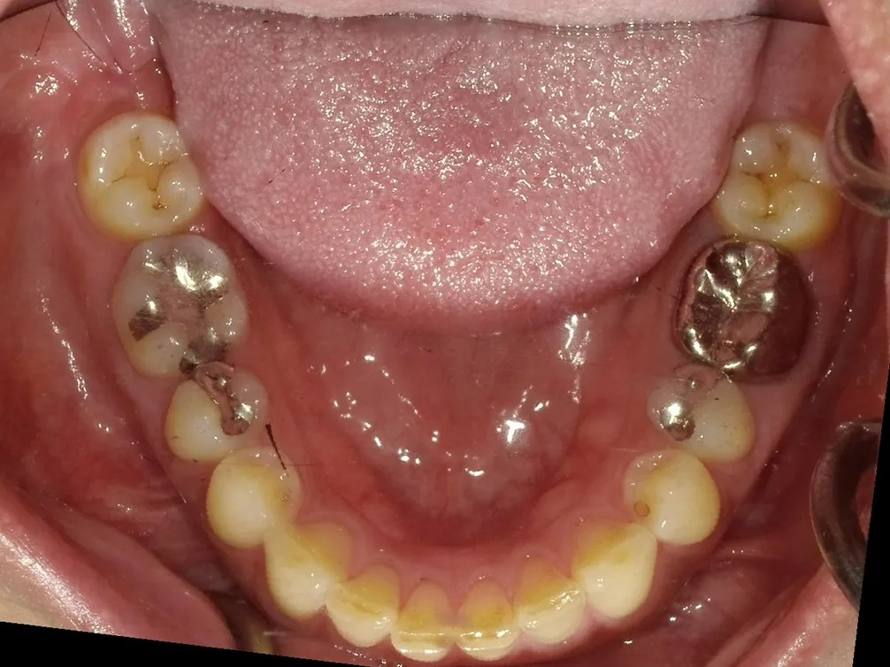 CASE14