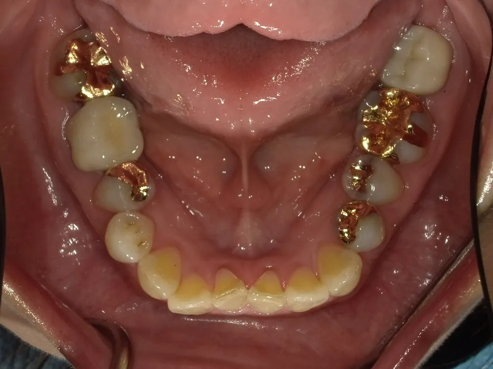 CASE11