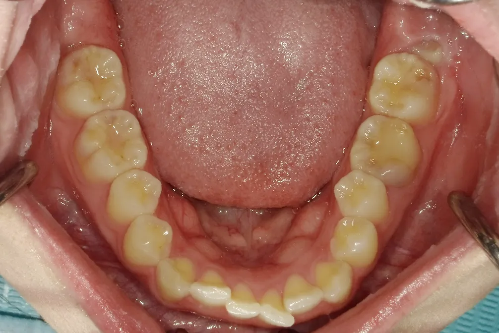 CASE26
