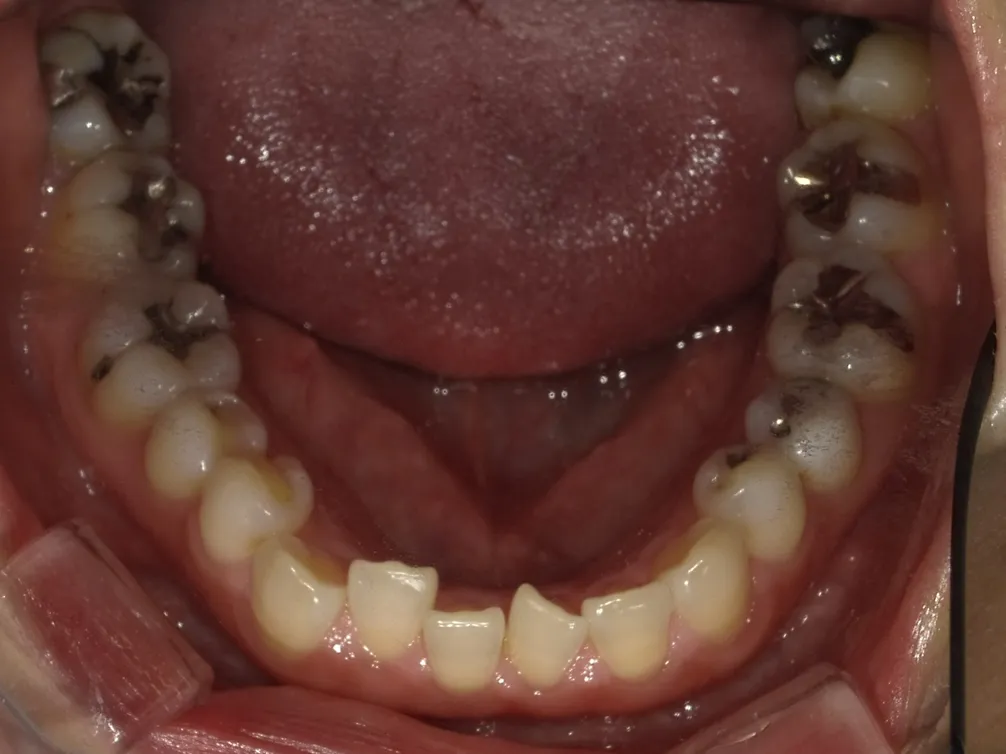CASE15