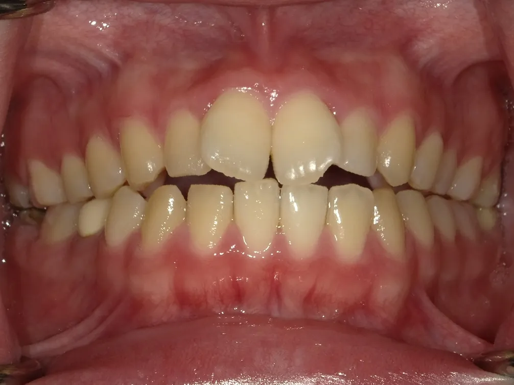 CASE21