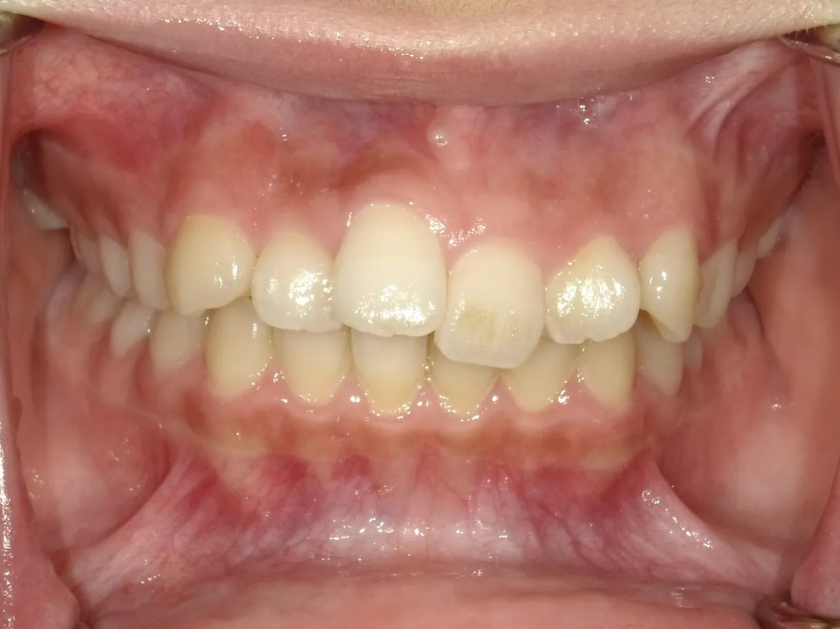 case17