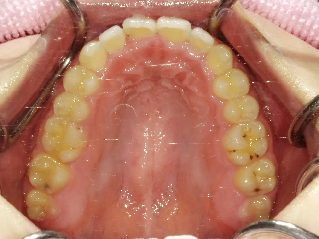 case17