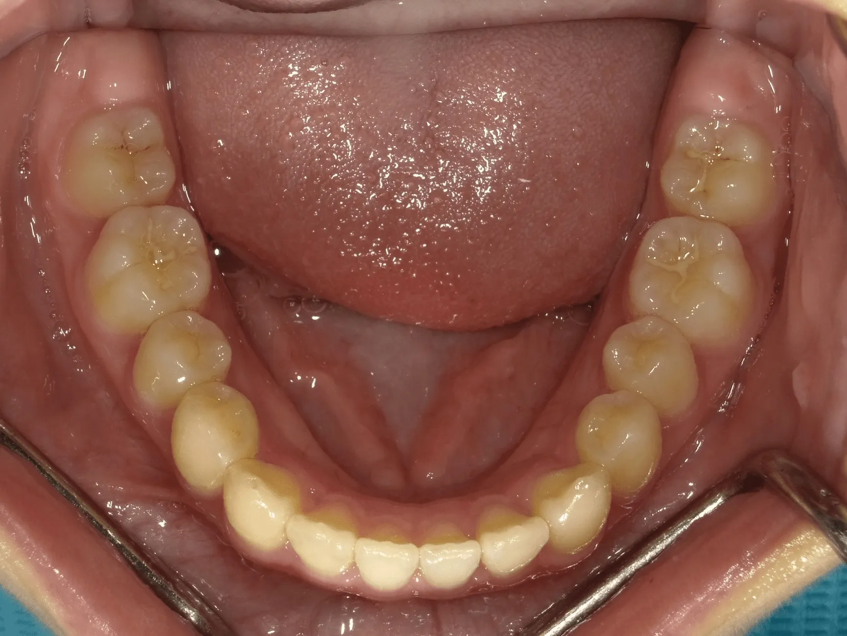 CASE12