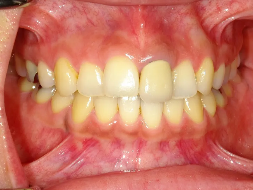 CASE11