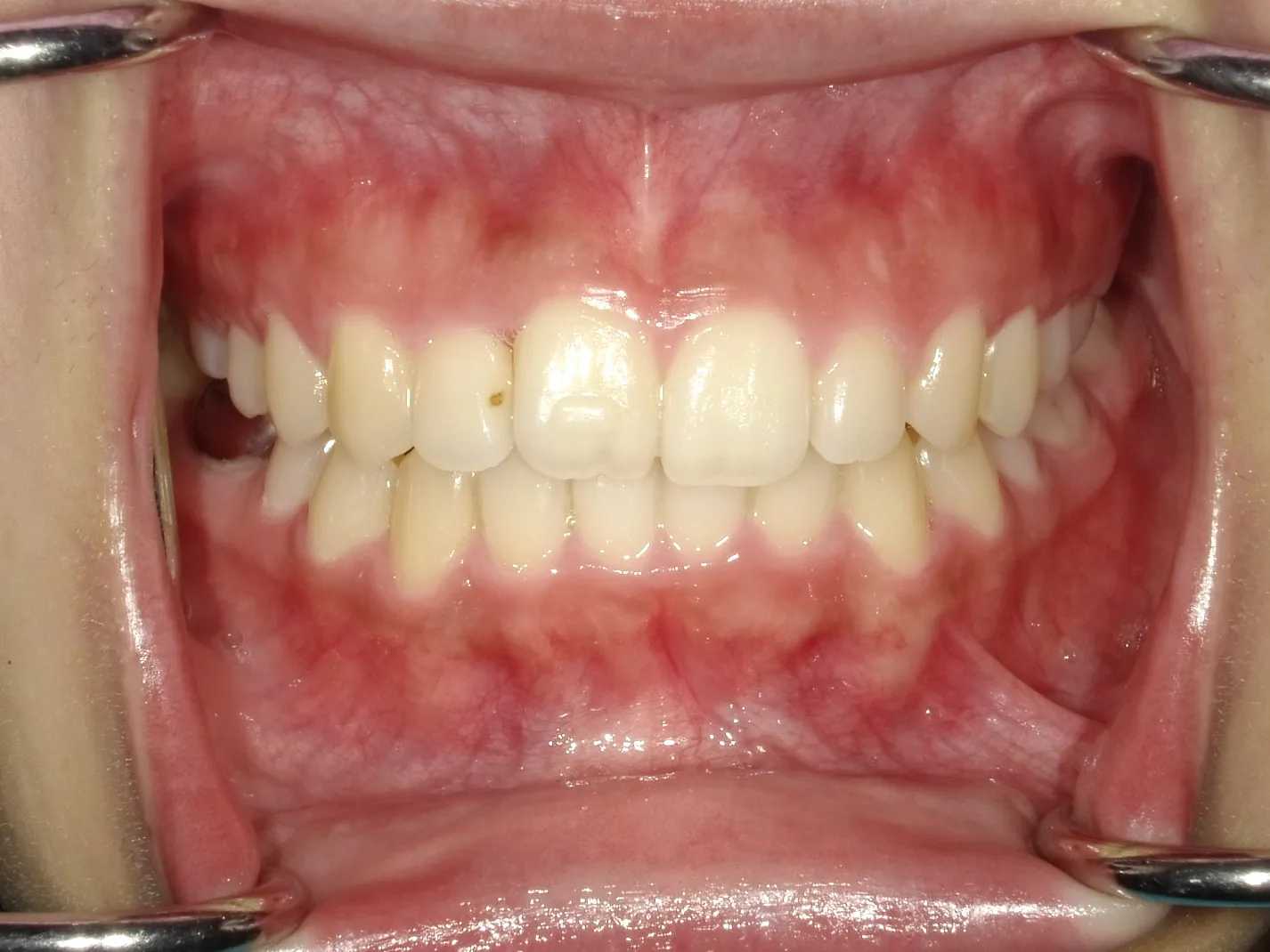 CASE17