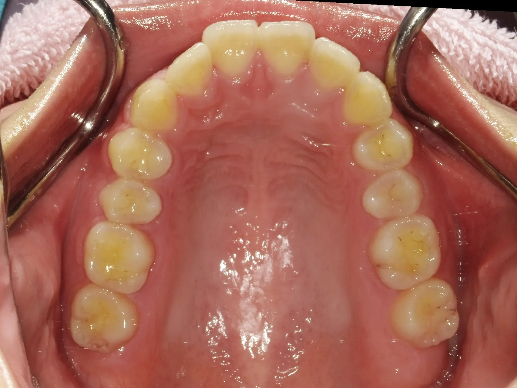 CASE21