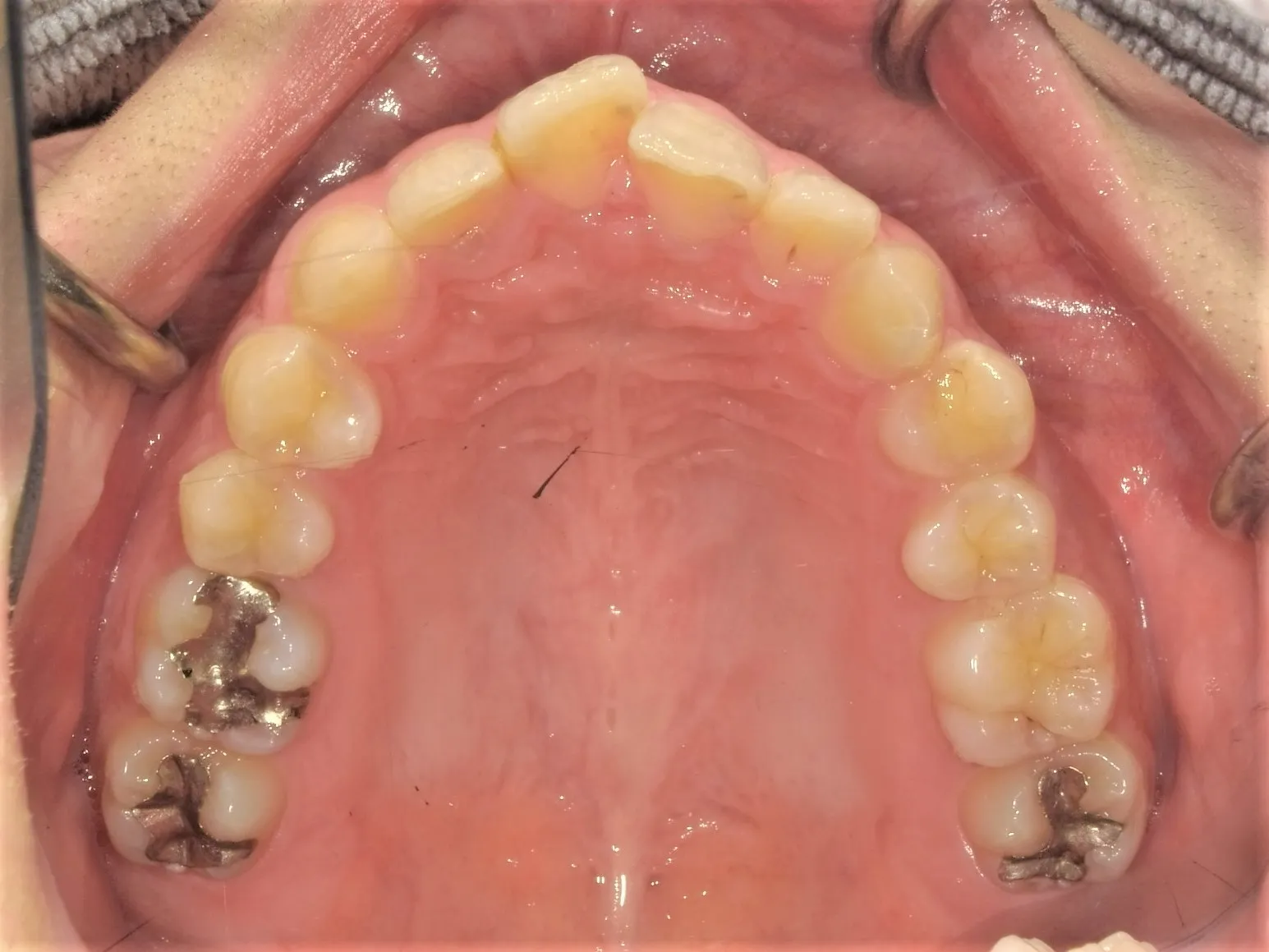 CASE21